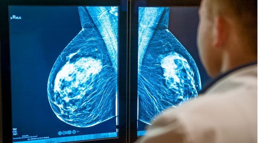 Final USPSTF Recommendation on  Breast Cancer Screening Lowers Starting Age from 50 to 40 Years / image credit mammogrpaphy: ©okrasiuk/stock.adobe.com