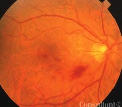 Branch Retinal Vein Occlusion With Macular Edema