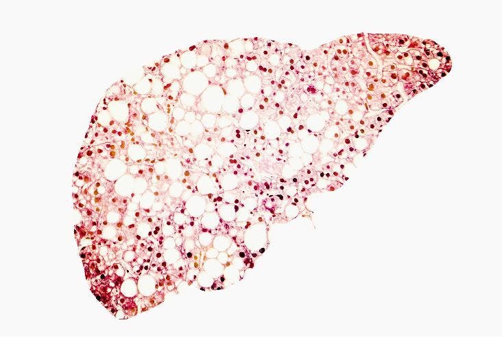 Nonalcoholic Fatty Liver Disease: A 7-question Quiz for Primary Care Clinicians