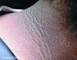 Acanthosis Nigricans in an Adolescent With Metabolic Syndrome