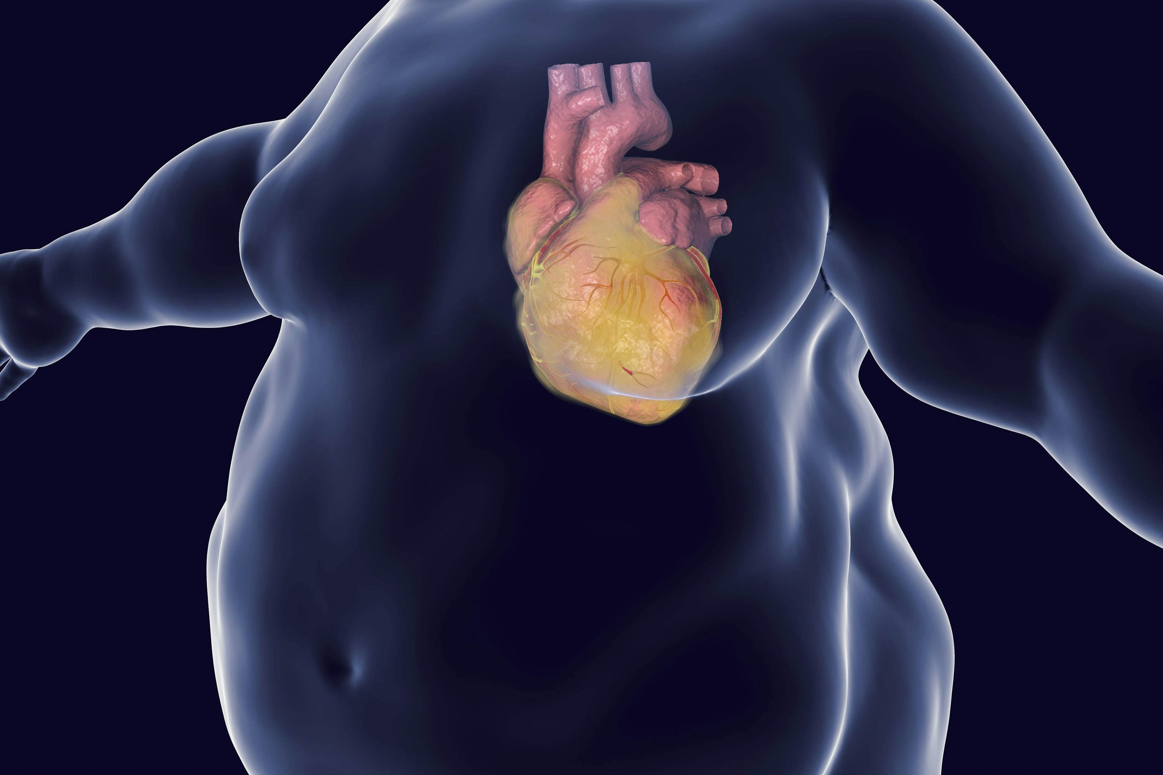 Heart disease in a person with obesity