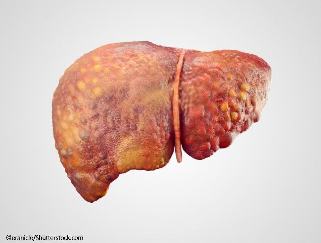 Does DAA Therapy Up Risk for Liver Cancer? It's Debatable 