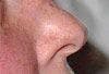 Wegener granulomatosis with saddle nose deformity