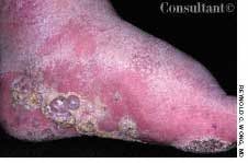 Lymphangiomas on a Patient's Foot