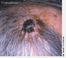 Malignant Melanoma: An Example of the American Flag Sign