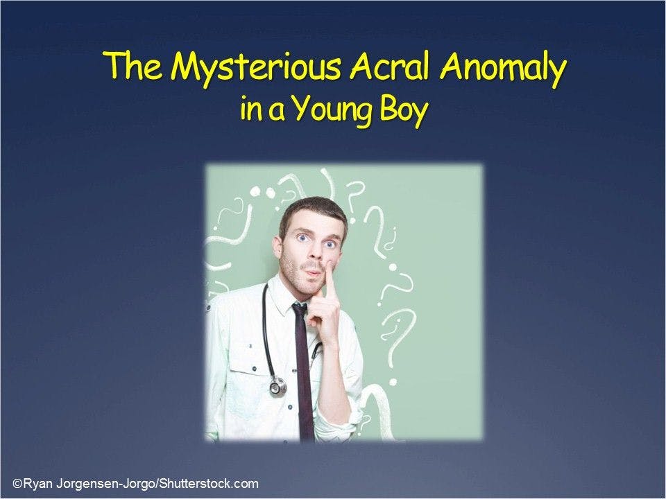 Acral Anomaly in a Young Boy 