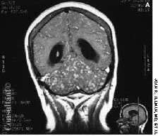 Cerebellar Blastomycotic Abscesses