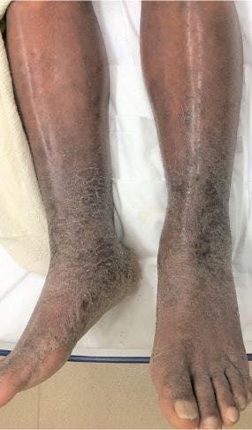 62-year-old man with bilateral lower extremity rash. 