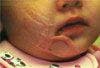 Severe Facial Scar on a Young Girl: Was This Child Abused?