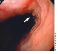 Idiopathic Esophageal Ulcer