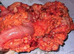Carcinomatosis