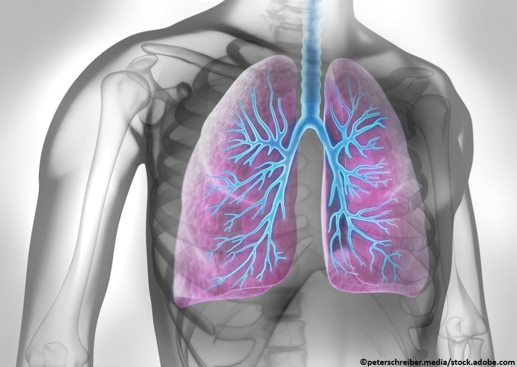 Significant Reductions in Exacerbations Seen in Broad Population of Severe Asthma Patients  