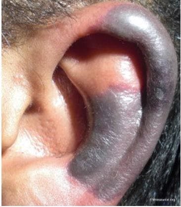 Bilateral Recurring Ear Pain and Discoloration in a 32-Year-Old Man 