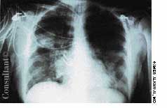 TB Presenting as Acute Respiratory Distress Syndrome