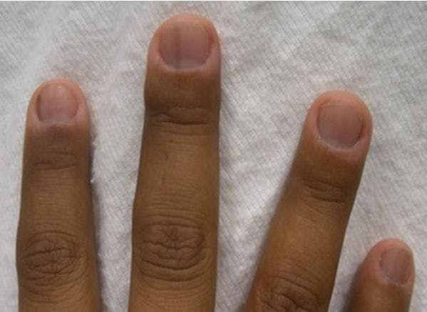 A 31-year-old Woman with Weakness and an Unusual Tan 