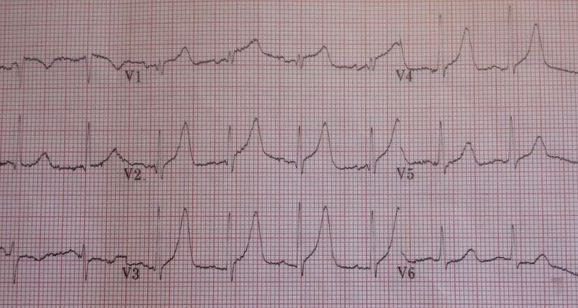 Chest Pain, Dyspnea, and a Negative Stress Test in a 46-Year-Old Man 