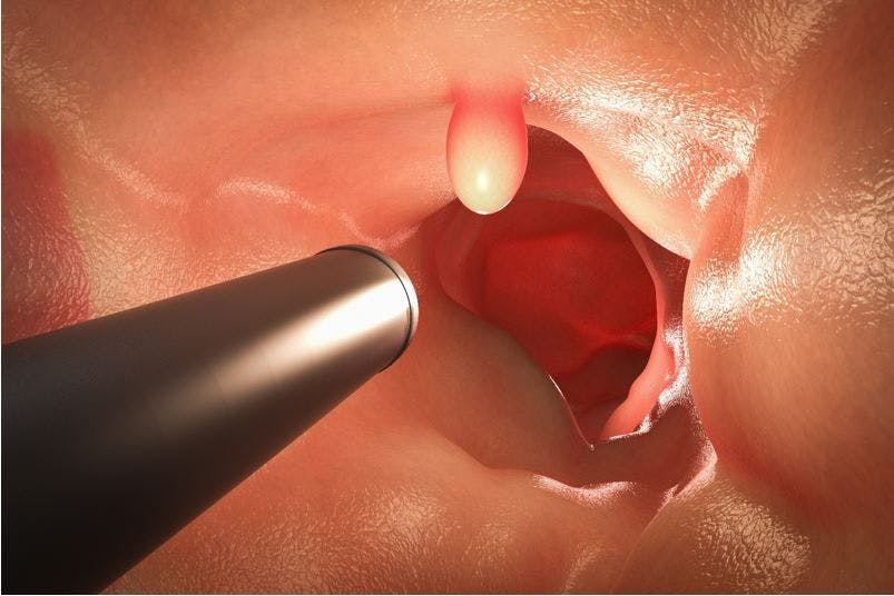 Can Colonoscopy Interval be Safely Extended from 10 to 15 Years for Individuals at Average CRC Risk?/ image credit colonoscopy: ©phonlamaiphoto/stock.adobe.com