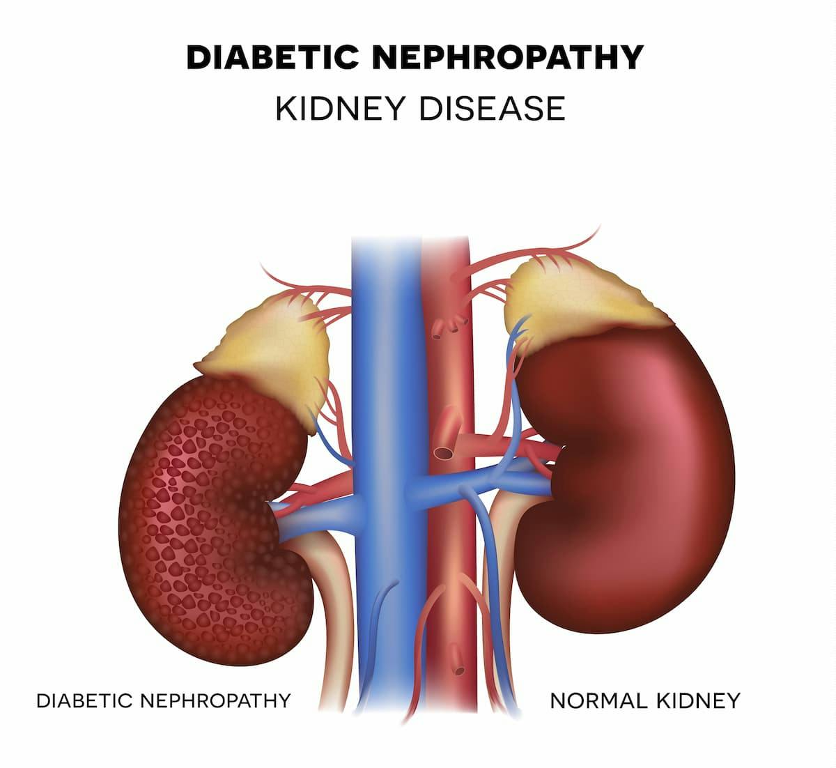 Renal Complications Drive Increase in Deaths Related to Vascular Complications in Adults with Diabetes