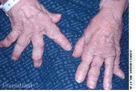 Rheumatoid Nodules in a Woman With 40-Year History of Rheumatoid Arthritis