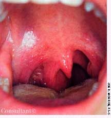 Deviated Uvula