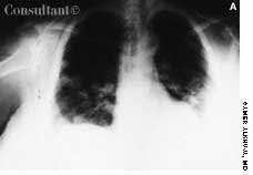 Asymptomatic 'Cannonballs' in the Lungs