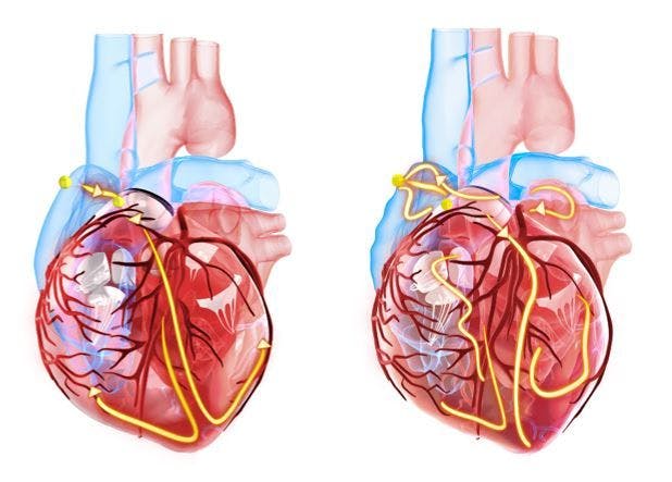 SGLT2 inhibitors may reduce risk of heart arrhythmias, sudden death 