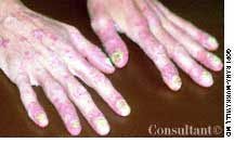 Psoriatic Arthritis in Hands and Fingers of a 38-Year-Old Woman