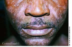Seborrheic Dermatitis and HIV