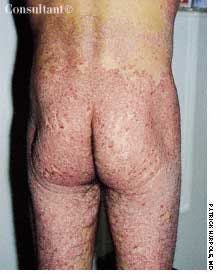AIDS-Related Psoriasis