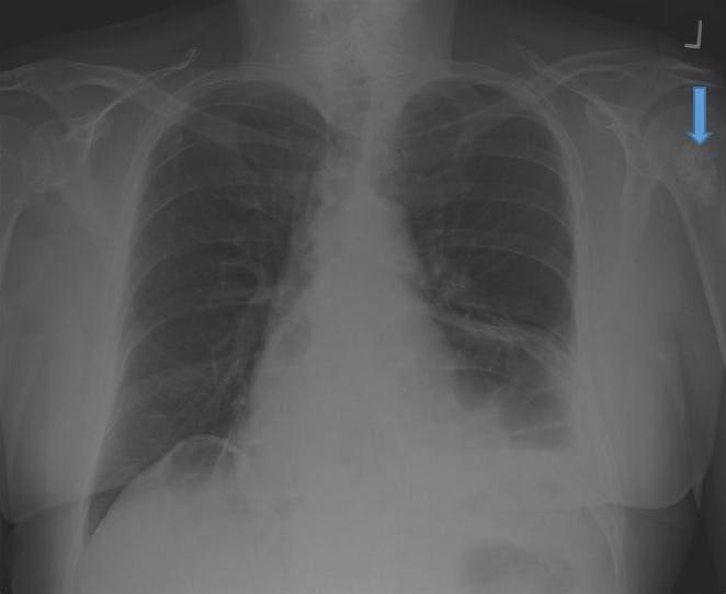 Incidental Lytic Lesion Seen on Chest Radiograph 