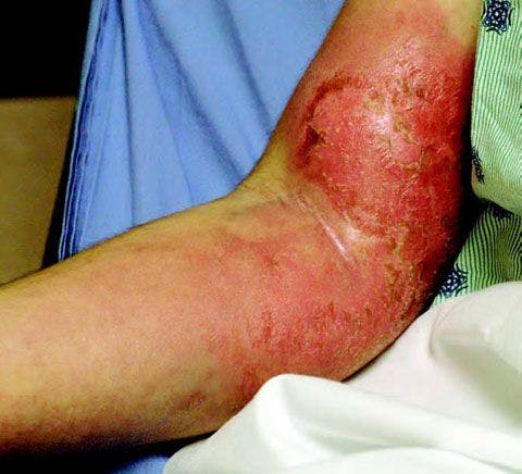 Disseminated Histoplasmosis in a Woman With History of Polymyositis and Possible Dermatomyositis