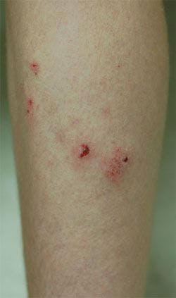 Case 2: How would you treat this pruritic eruption that resists topical corticosteroids?