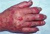 Skin Disorders Video 8: Psoriasis Treatment With Biologics