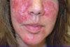 Skin Disorders Video 5: Rosacea