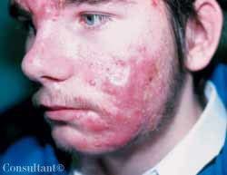 Refractory Acne Vulgaris on the Face of a Teenage Boy