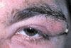 Mechanical Ptosis in 39-Year-Old Man