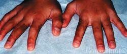 Phytophotodermatitis on Fingers of a Young Child