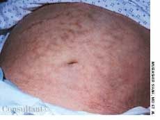 Erythema ab Igne in a 62-Year-Old Woman