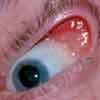 Floppy Eyelid Syndrome