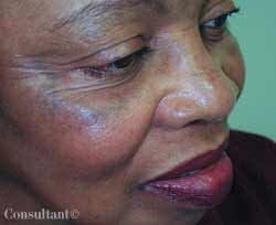 Ochronosis in a 58-year-old African American Woman 