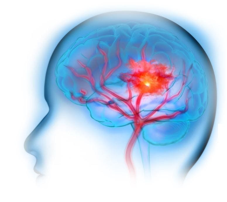 CV Risk Prevention Profiles Significantly Worse Following Stroke vs MI in 2 Large National Cohorts / image credit brain bleed: ©cpdesign1/stock.adobe.com