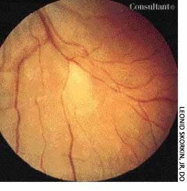 Acute Retinal Lesion From Toxoplasmosis