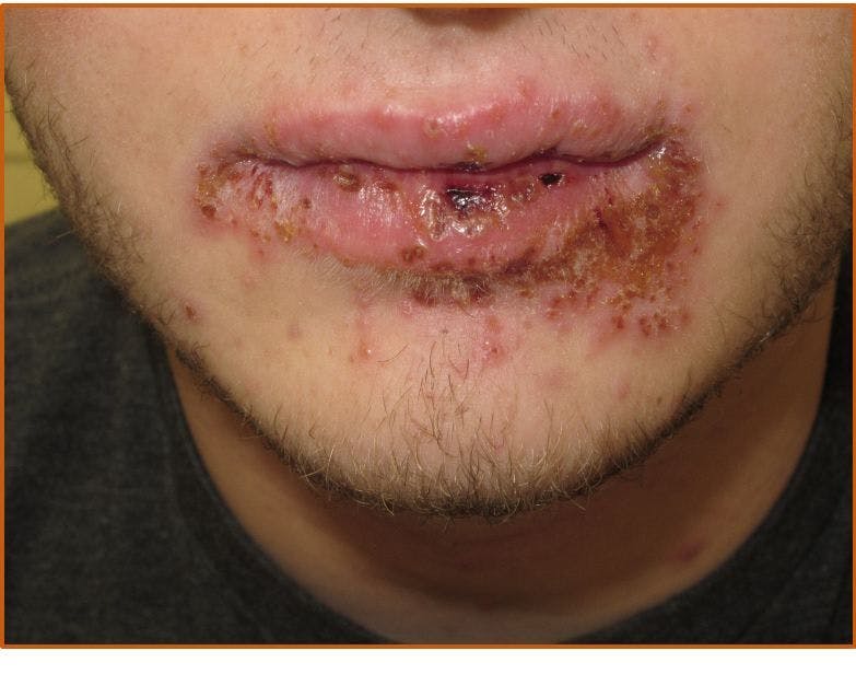 Eczema Herpeticum and Impetigo: What's the Common Underlying Problem? 