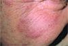 Are these erythematous plaques rosacea-or something else?