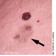 Lymphoepithelial Cysts in a Patient with HIV: Is HAART the Answer?