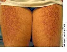 Erythema ab Igne on the Thighs of a 53-Year-Old Man