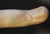 Does this hand lesion signal underlying disease?