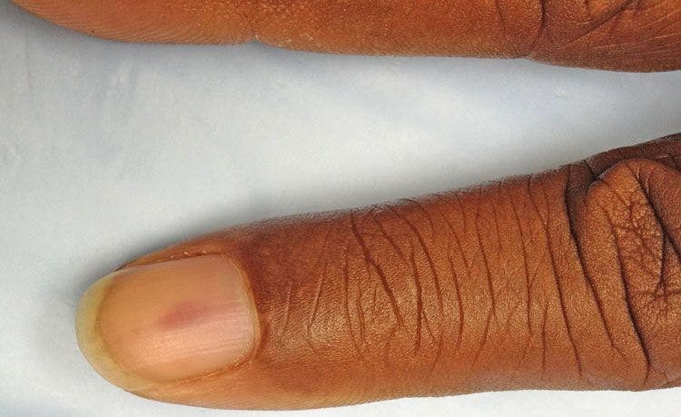 Go For The Glory Quiz: Nail Discoloration; Candidiasis; Nevus; Phrenic Nerve