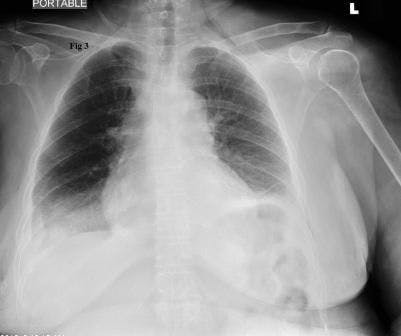 Re-expansion pulmonary edema