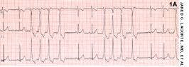 Nonsustained Ventricular Tachycardia